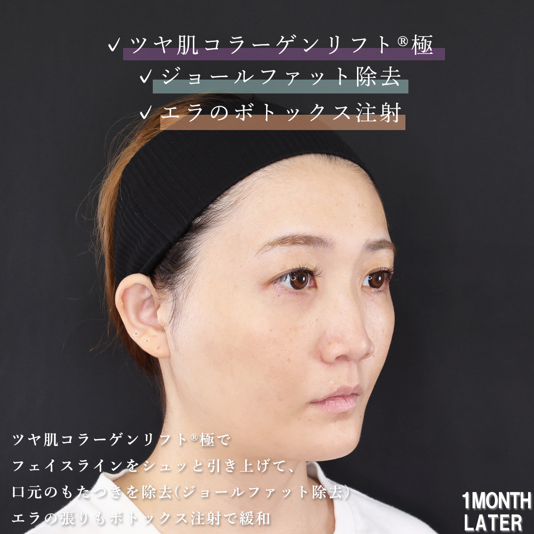 ジョールファット除去/TAC式 ツヤ肌コラーゲンリフト®/エラボトックス注射の症例写真 施術前後 