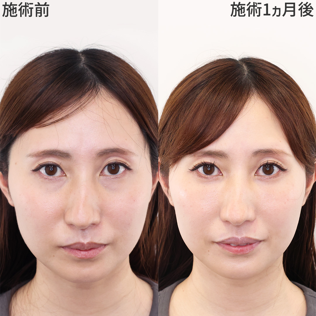下眼瞼脱脂術(目の下のたるみ取り・目の下の脂肪ふくらみ取り)/顔の脂肪注入(コンデンスリッチフェイス)の症例写真 施術前後