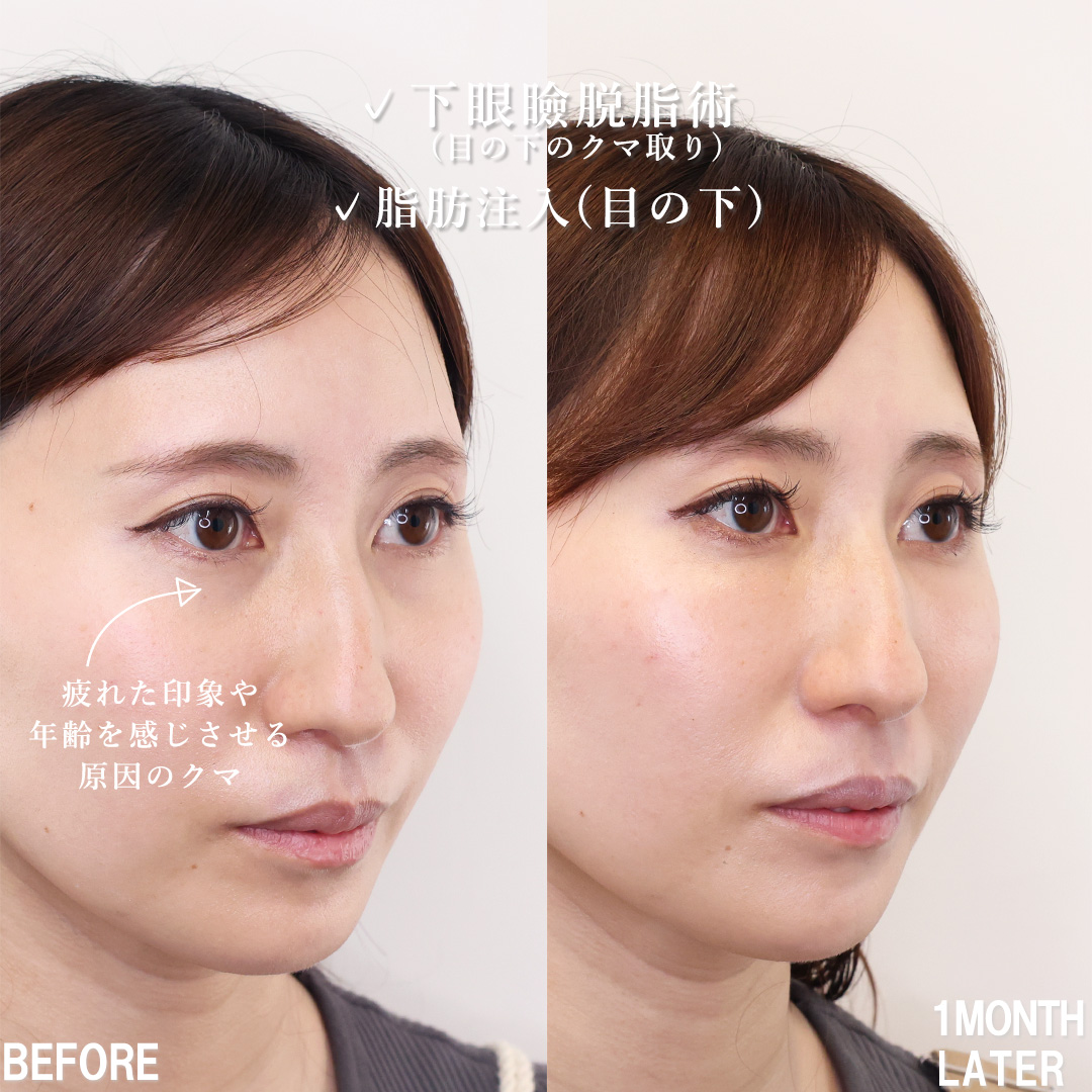 下眼瞼脱脂術(目の下のたるみ取り・目の下の脂肪ふくらみ取り)/顔の脂肪注入(コンデンスリッチフェイス)の症例写真 施術前後