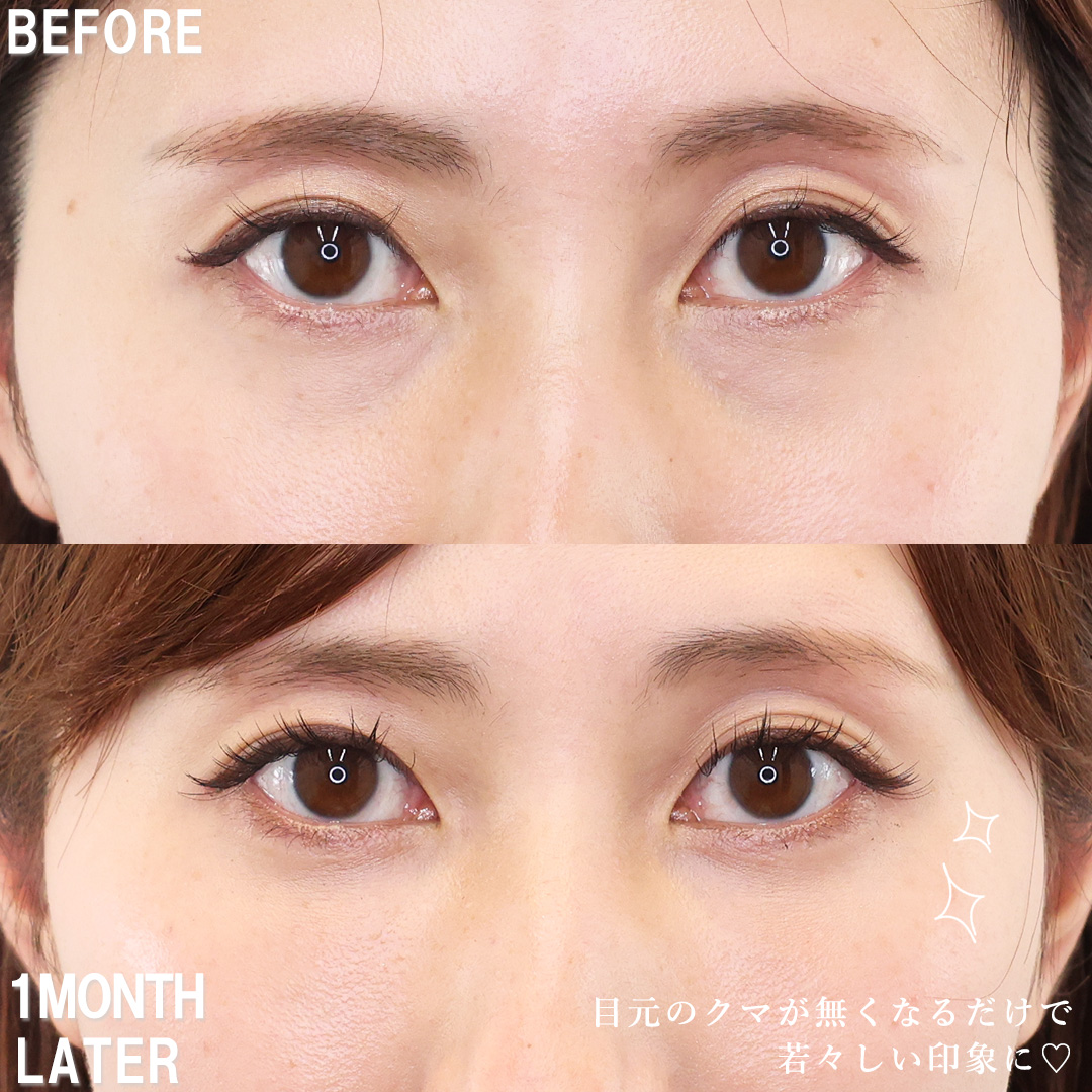 下眼瞼脱脂術(目の下のたるみ取り・目の下の脂肪ふくらみ取り)/顔の脂肪注入(コンデンスリッチフェイス)の症例写真 施術前後