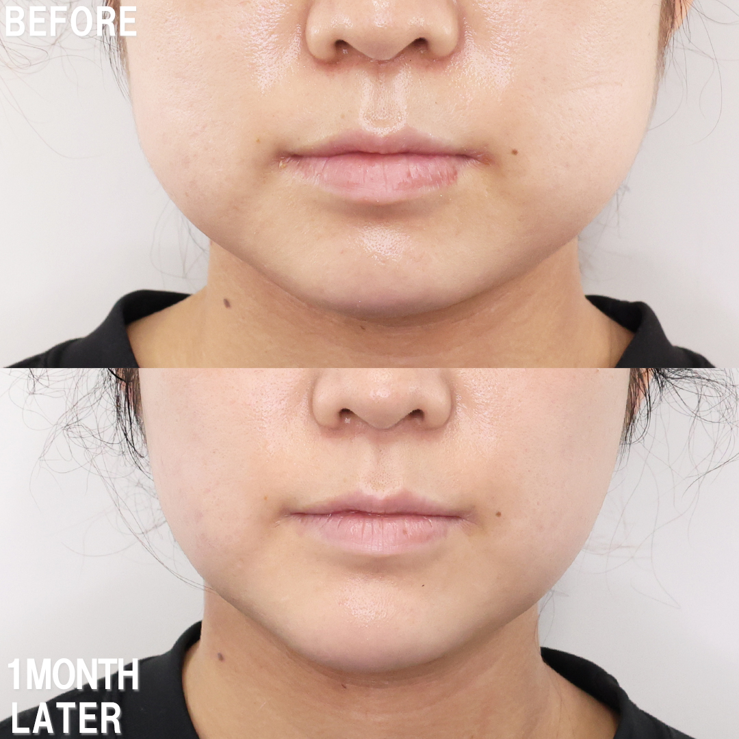 小顔整形｜パーフェクトフェイスライン/バッカルファット除去/TAC式 ツヤ肌コラーゲンリフト®の症例写真 施術前後 