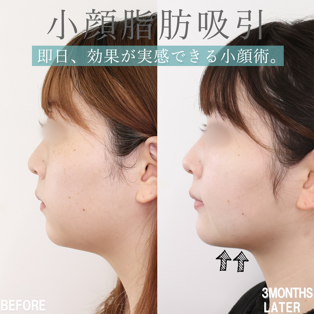 小顔整形｜パーフェクトフェイスライン/TAC式 ツヤ肌コラーゲンリフト®/顎下の脂肪吸引の症例写真 施術前後 ３ヵ月