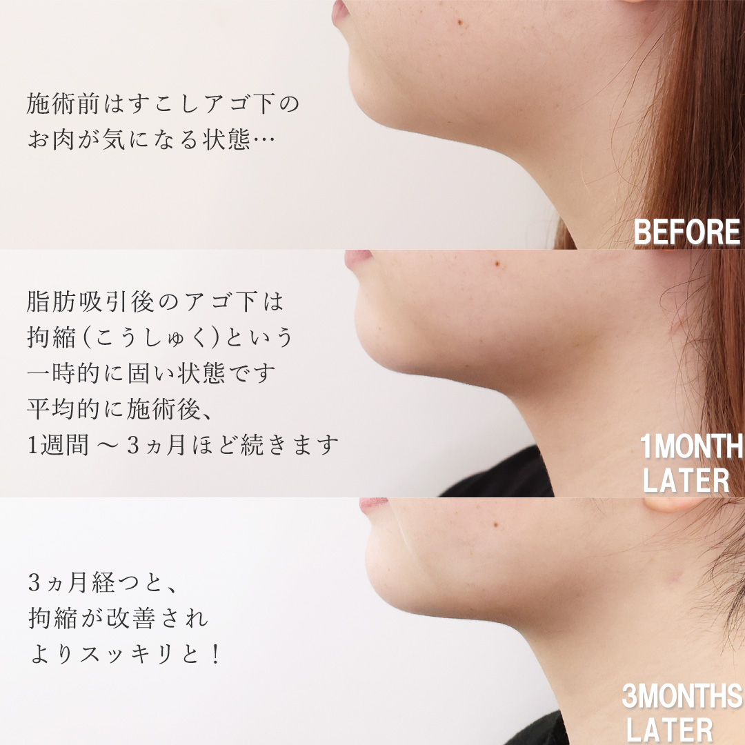 小顔整形｜パーフェクトフェイスライン/TAC式 ツヤ肌コラーゲンリフト®/顎下の脂肪吸引の症例写真 施術前後 ３ヵ月