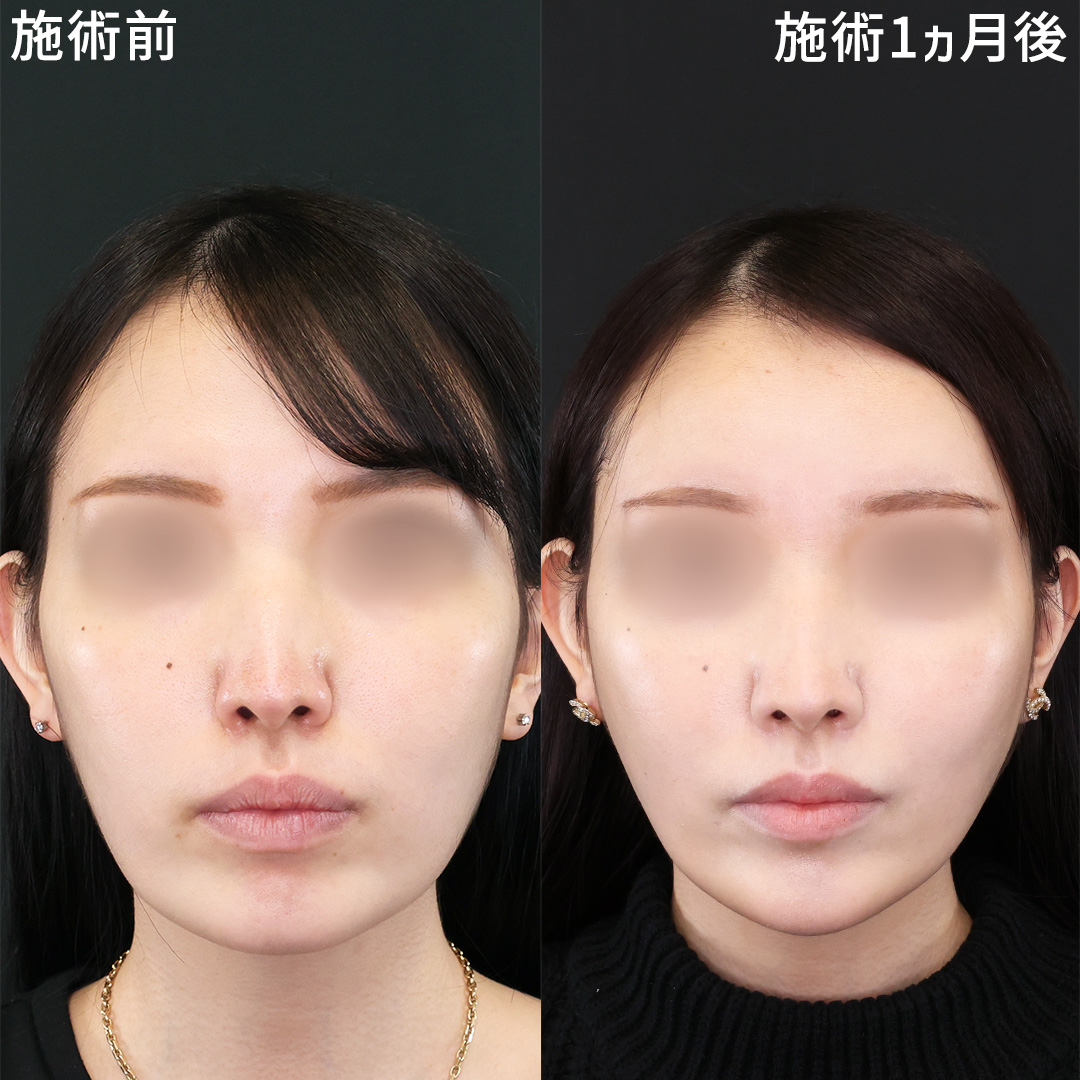 複合施術[糸リフト+クマ取り] でより若々しい印象に