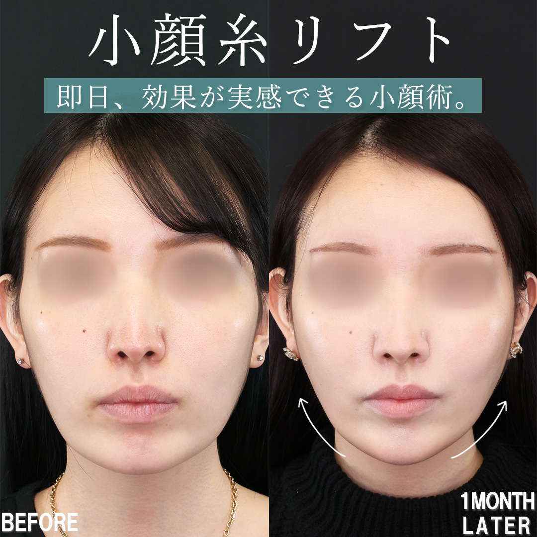 下眼瞼脱脂術(目の下のたるみ取り・目の下の脂肪ふくらみ取り)/TAC式 ツヤ肌コラーゲンリフト®/おでこ・こめかみのヒアルロン酸注射の症例写真 施術前後 1ヵ月