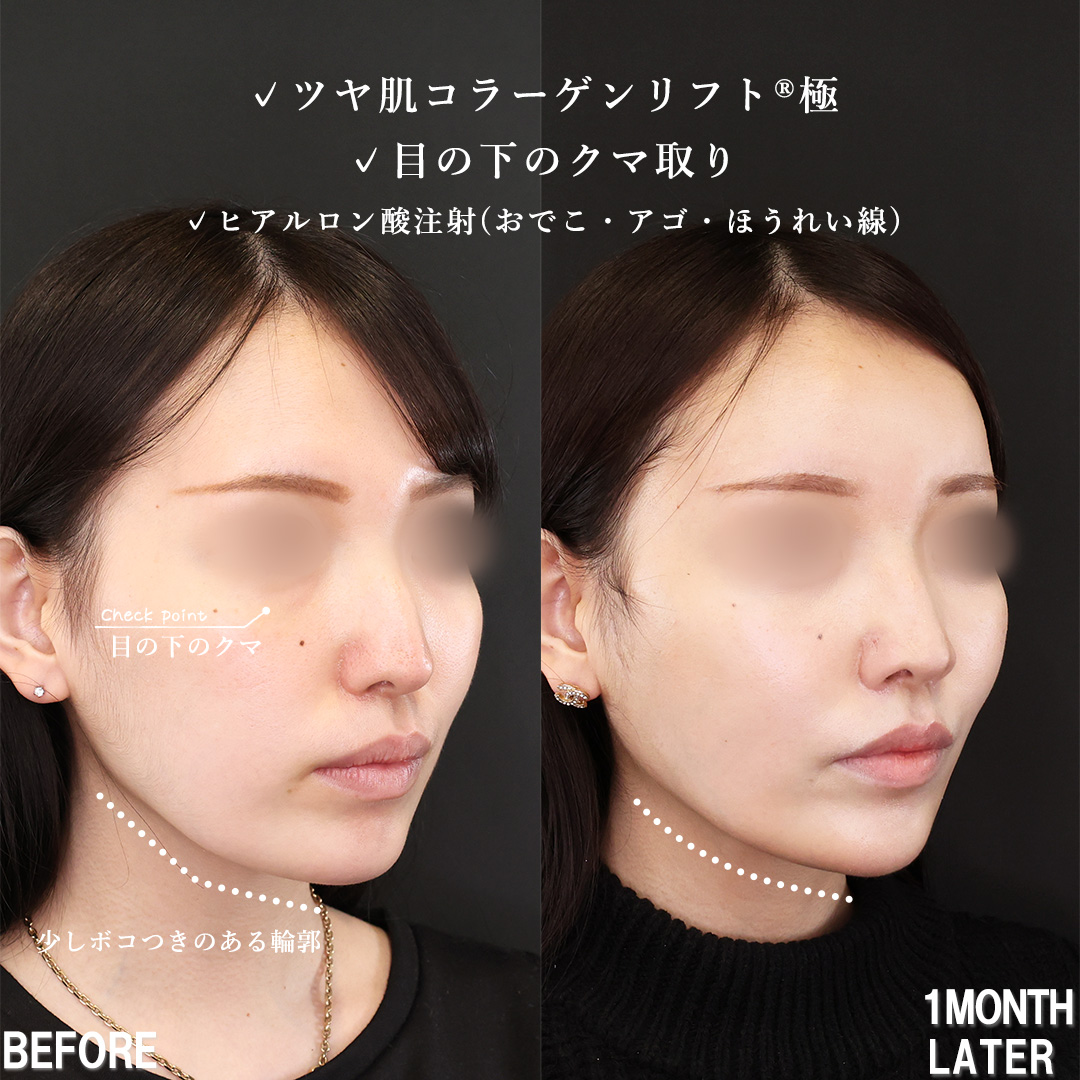 下眼瞼脱脂術(目の下のたるみ取り・目の下の脂肪ふくらみ取り)/TAC式 ツヤ肌コラーゲンリフト®/おでこ・こめかみのヒアルロン酸注射の症例写真 施術前後 1ヵ月