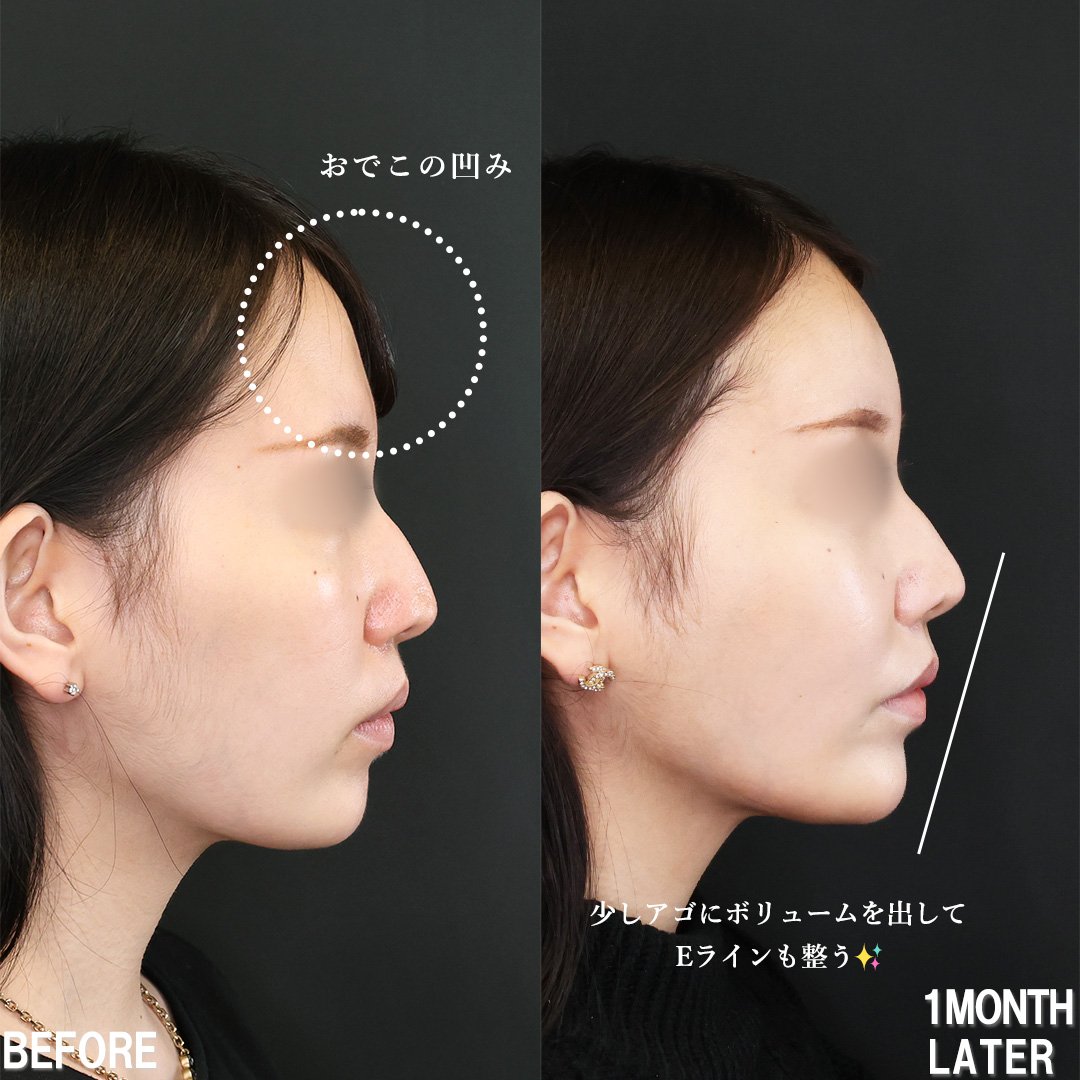 下眼瞼脱脂術(目の下のたるみ取り・目の下の脂肪ふくらみ取り)/TAC式 ツヤ肌コラーゲンリフト®/おでこ・こめかみのヒアルロン酸注射の症例写真 施術前後 1ヵ月