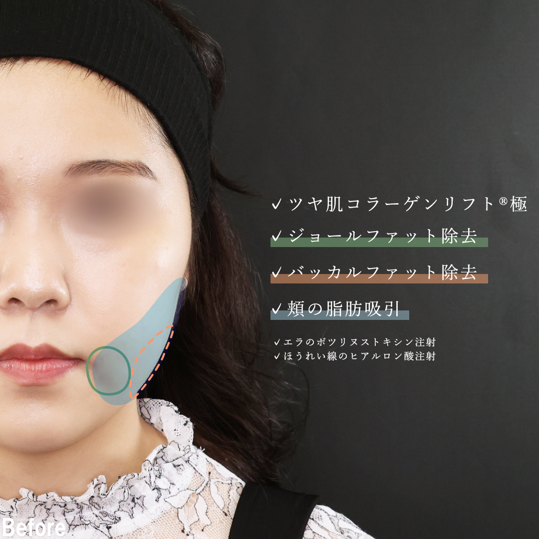 TAC式 ツヤ肌コラーゲンリフト®/バッカルファット除去/ジョールファット除去の症例写真 施術前後 