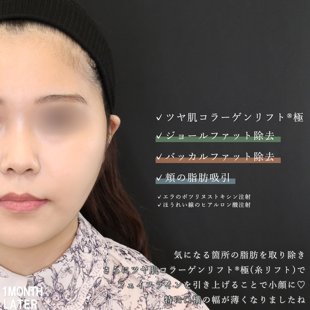 TAC式 ツヤ肌コラーゲンリフト®/バッカルファット除去/ジョールファット除去の症例写真 施術前後 