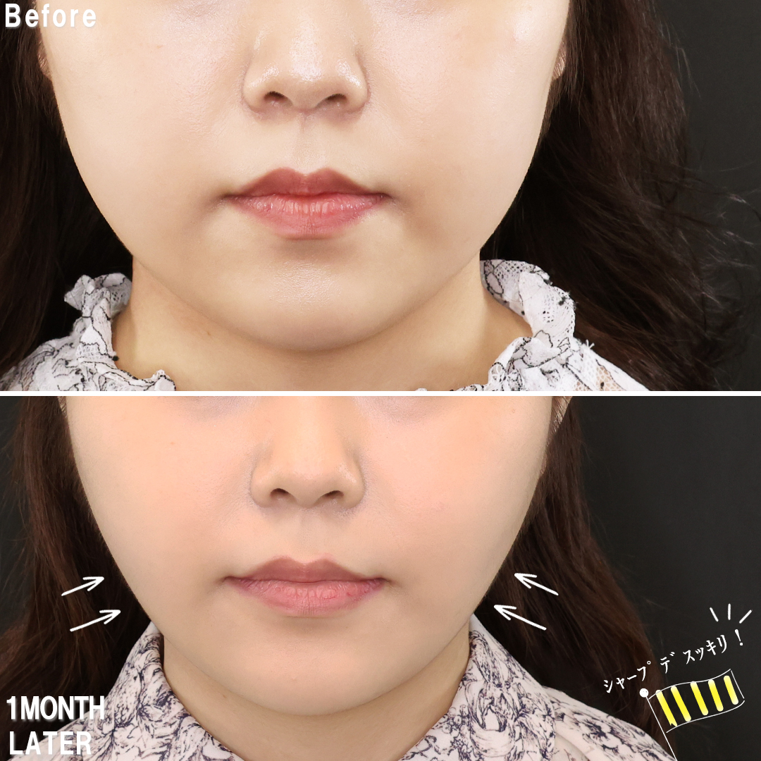 TAC式 ツヤ肌コラーゲンリフト®/バッカルファット除去/ジョールファット除去の症例写真 施術前後 