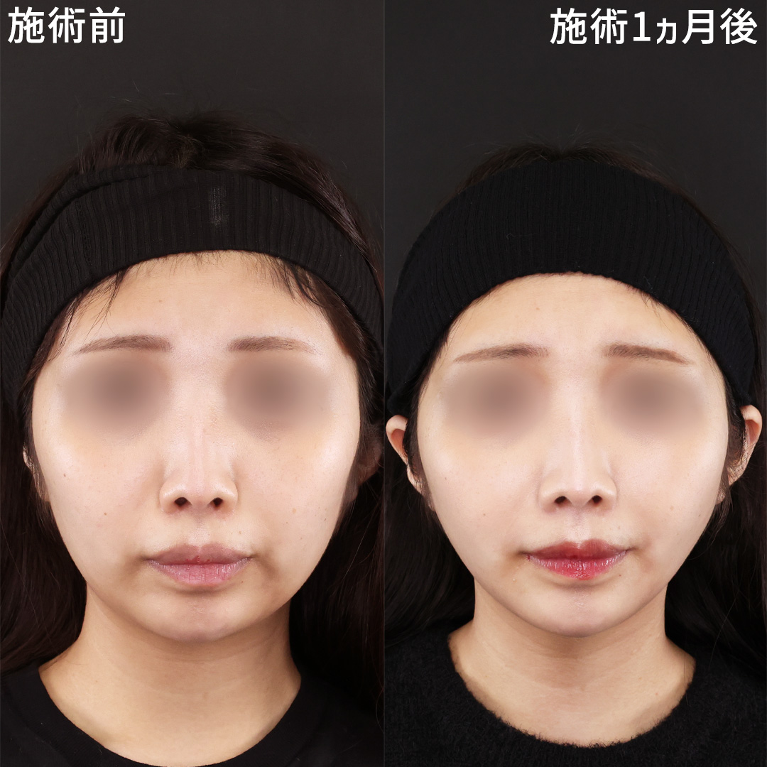 TAC式 ツヤ肌コラーゲンリフト®/ジョールファット除去/顔の脂肪吸引の症例写真 施術前後 