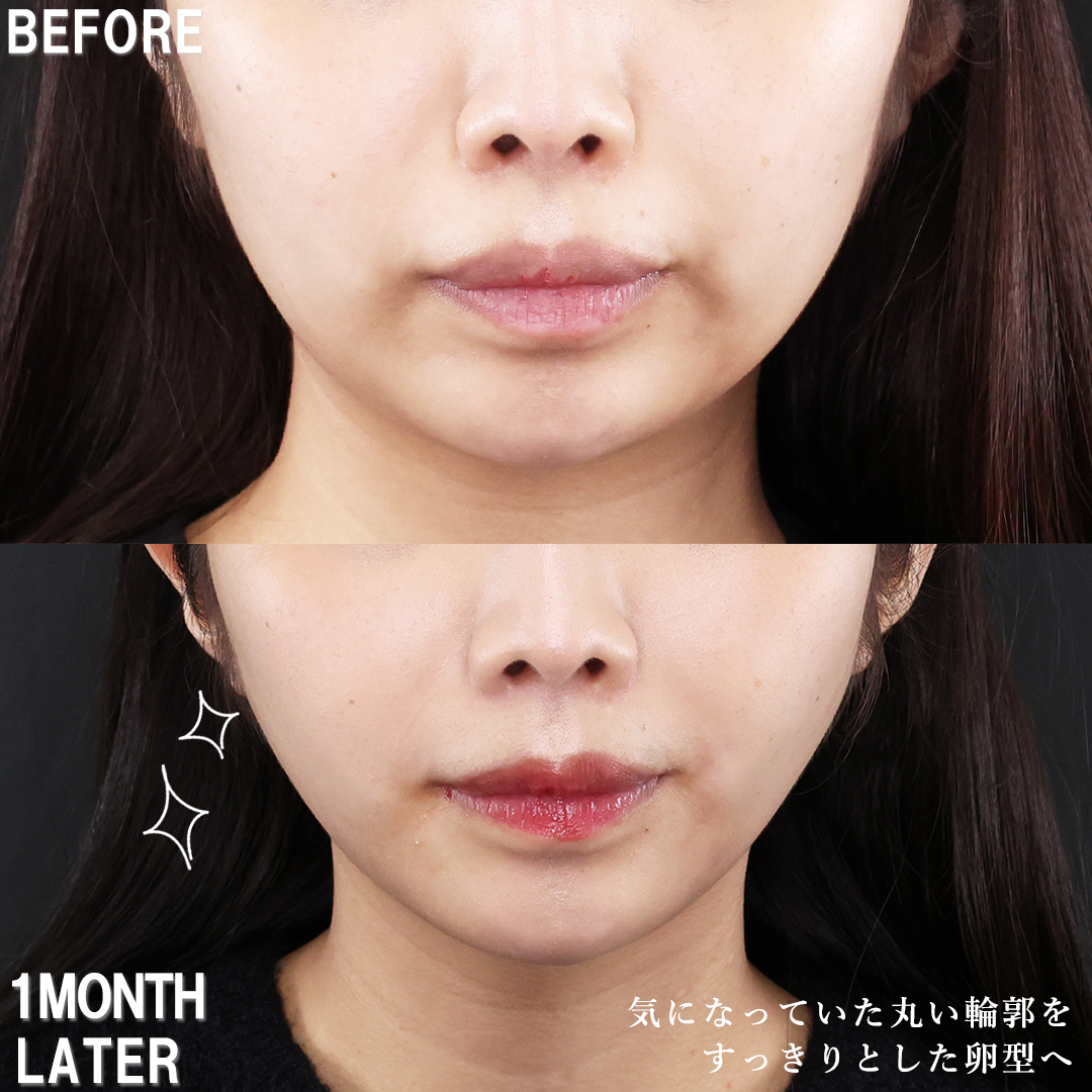 TAC式 ツヤ肌コラーゲンリフト®/ジョールファット除去/顔の脂肪吸引の症例写真 施術前後 