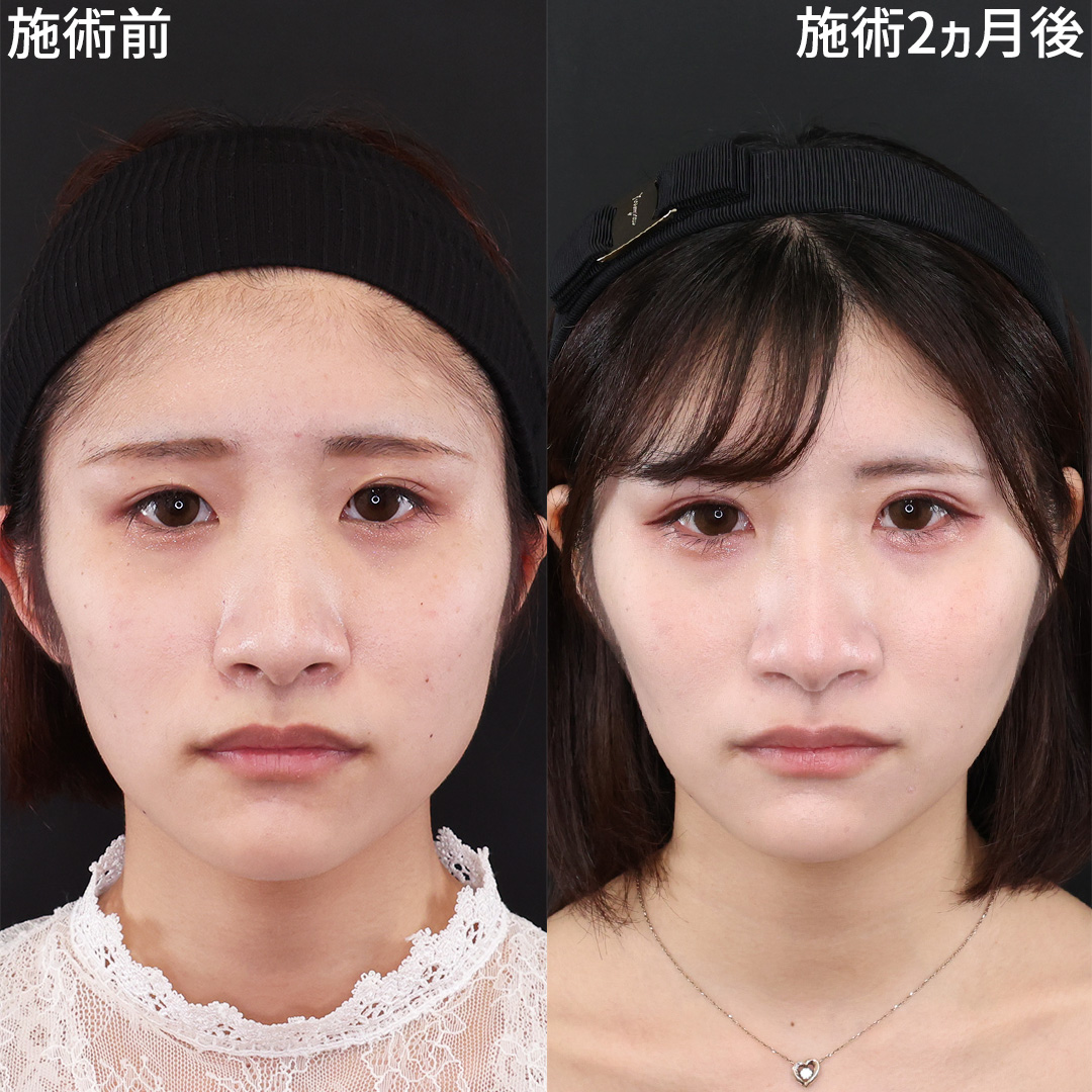 糸リフトで一回り小顔に！