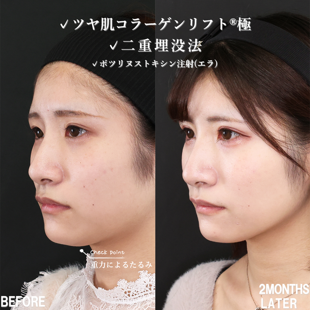 TAC式 ツヤ肌コラーゲンリフト®/二重埋没法/エラボトックス注射の症例写真 施術前後 