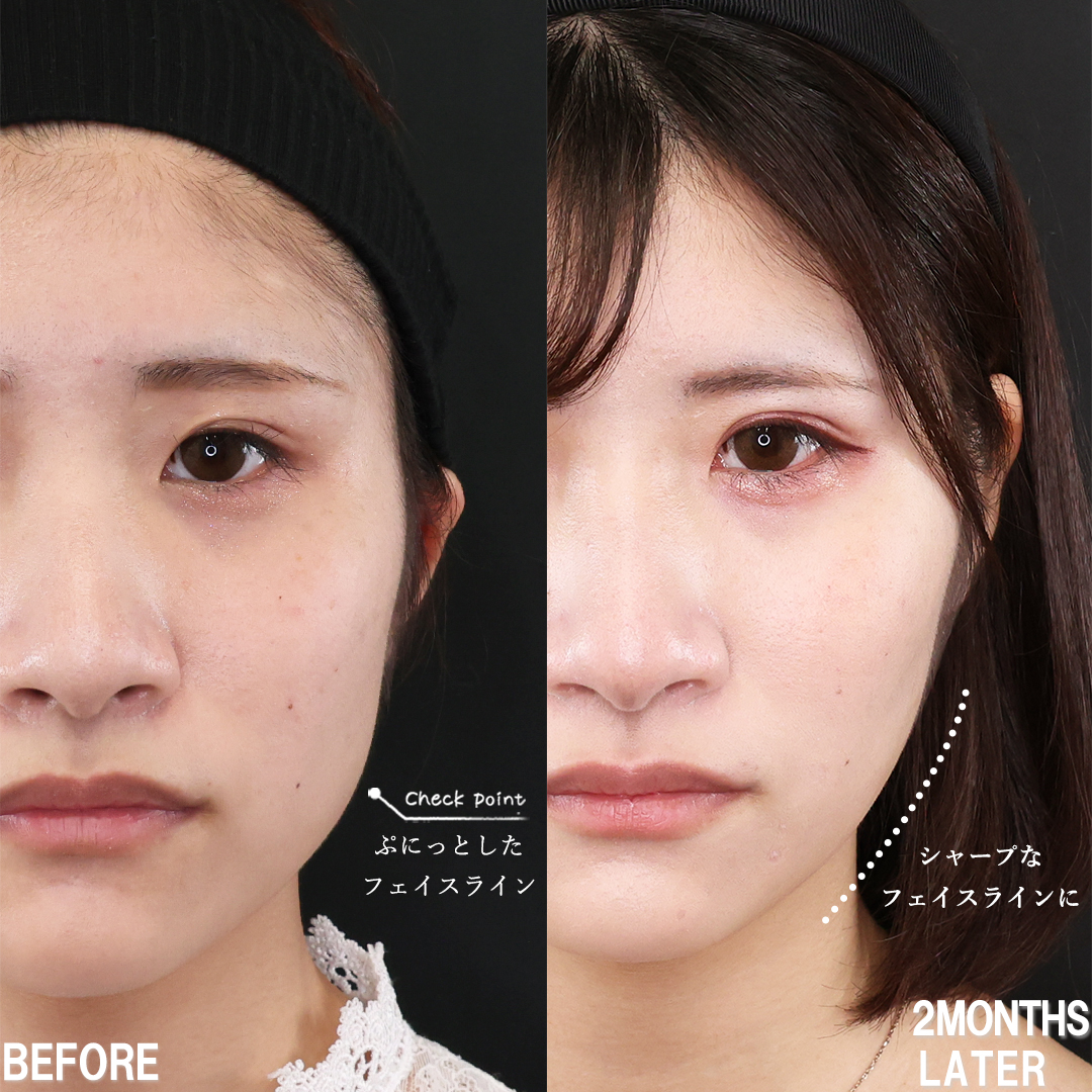 TAC式 ツヤ肌コラーゲンリフト®/二重埋没法/エラボトックス注射の症例写真 施術前後 