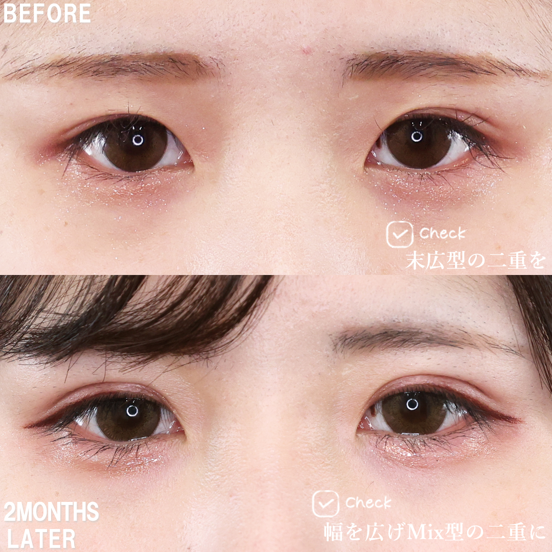 TAC式 ツヤ肌コラーゲンリフト®/二重埋没法/エラボトックス注射の症例写真 施術前後 