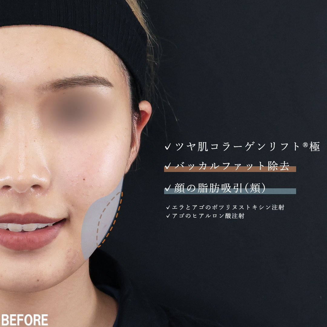 小顔整形｜パーフェクトフェイスライン/TAC式 ツヤ肌コラーゲンリフト®/バッカルファット除去の症例写真 施術前後 