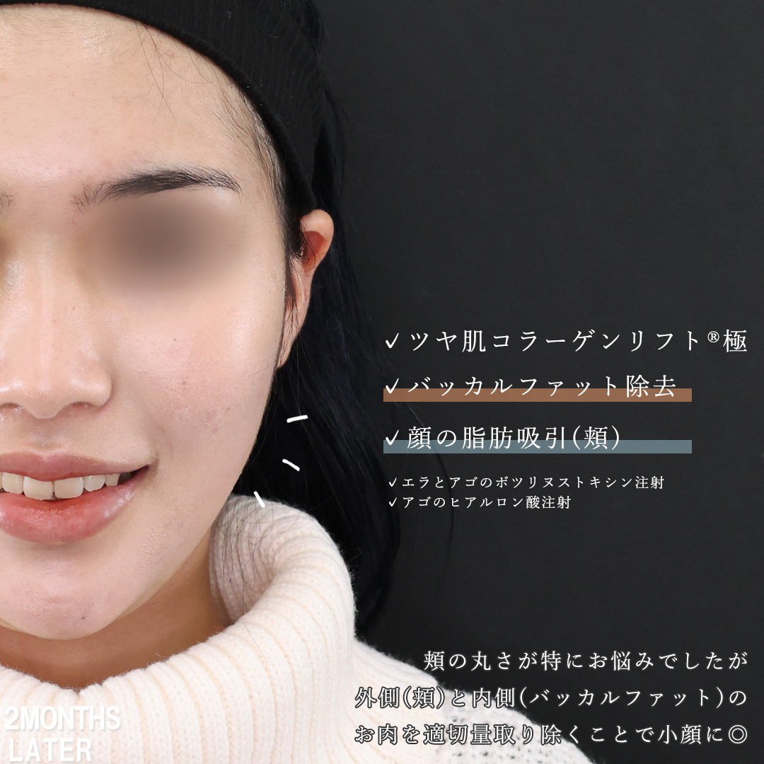 小顔整形｜パーフェクトフェイスライン/TAC式 ツヤ肌コラーゲンリフト®/バッカルファット除去の症例写真 施術前後 