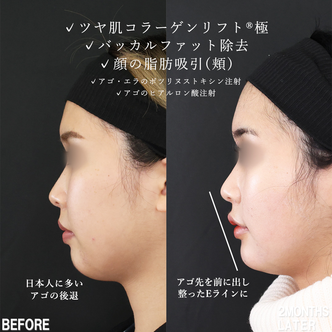 小顔整形｜パーフェクトフェイスライン/TAC式 ツヤ肌コラーゲンリフト®/バッカルファット除去の症例写真 施術前後 