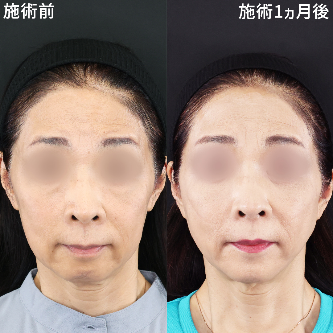 60代】リフトアップで若々しい印象に｜症例写真・ビフォーアフター｜美容整形・美容外科のTAクリニックグループ