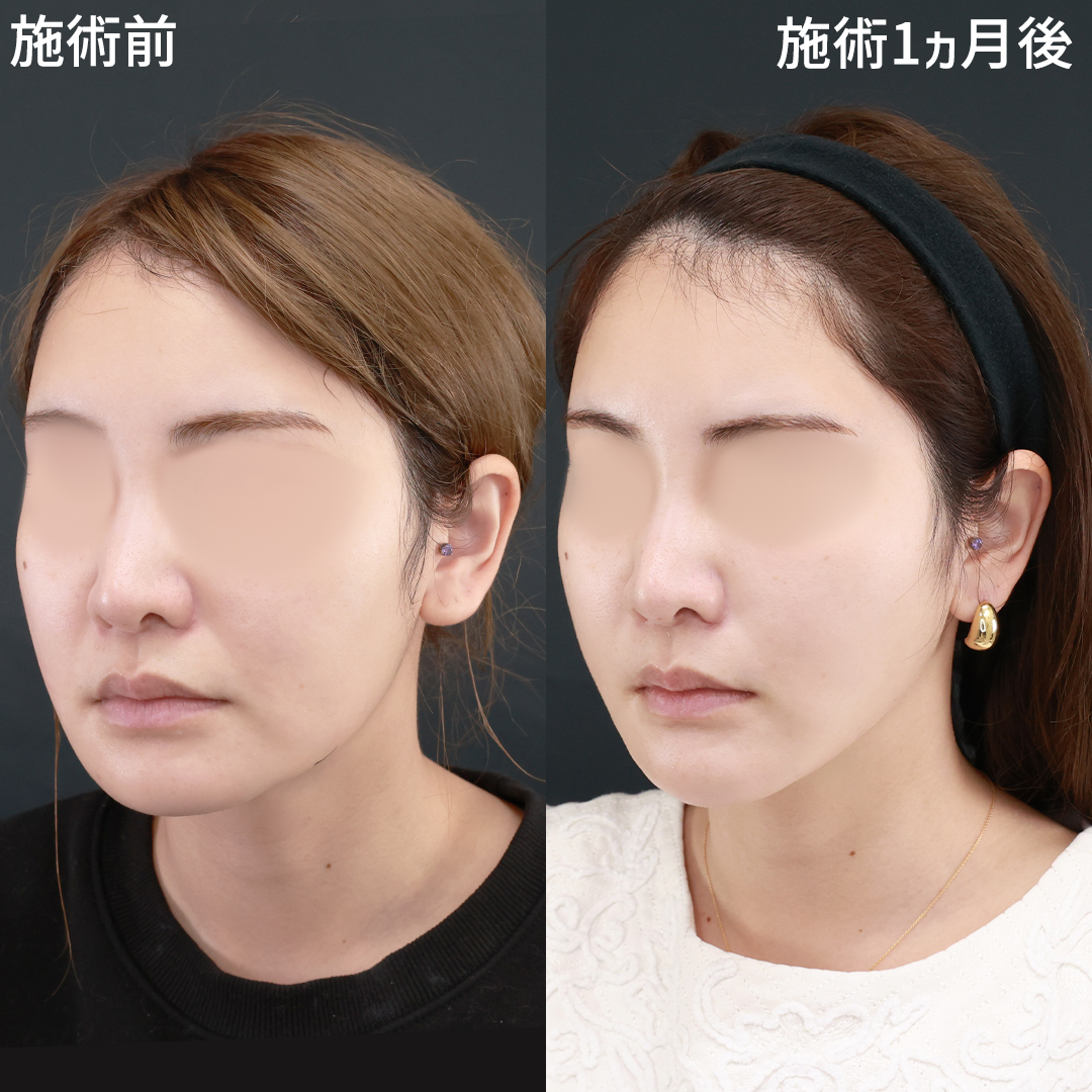 TAC式 ツヤ肌コラーゲンリフト®/顎のヒアルロン酸注射/エラボトックス注射の症例写真 施術前後