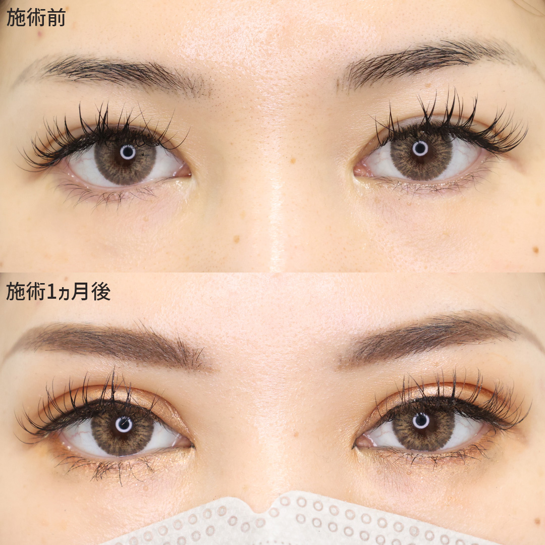 まるでハーフの様なぱっちり二重に【埋没法】