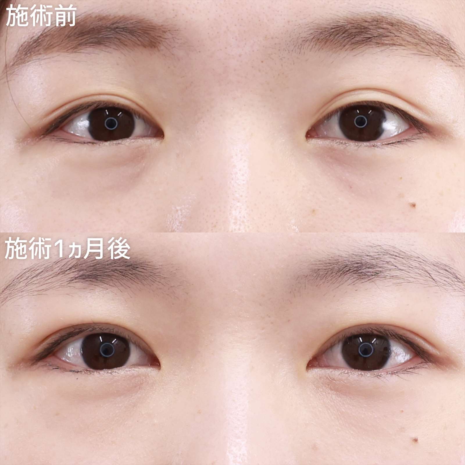 二重埋没法の症例写真 施術前後 