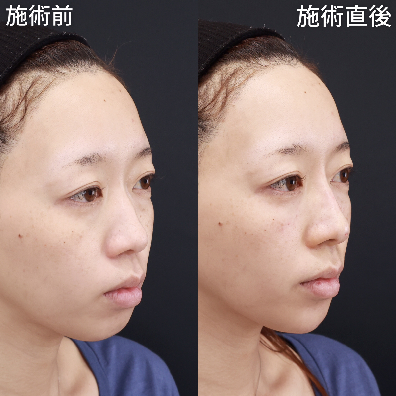 ヴィーナスノーズ（切らない鼻中隔延長術）/鼻のヒアルロン酸注射/目の下のヒアルロン酸注射の症例写真 施術前後 