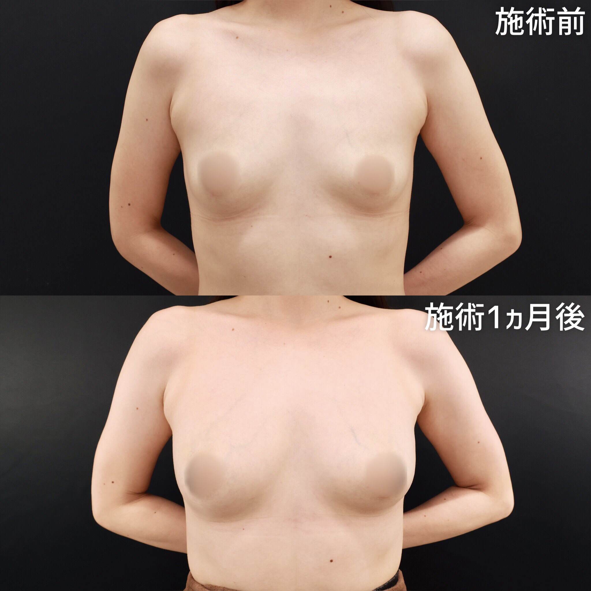脂肪注入豊胸（コンデンスリッチ・ピュアグラフト・１day脂肪豊胸）の症例写真 施術前後 