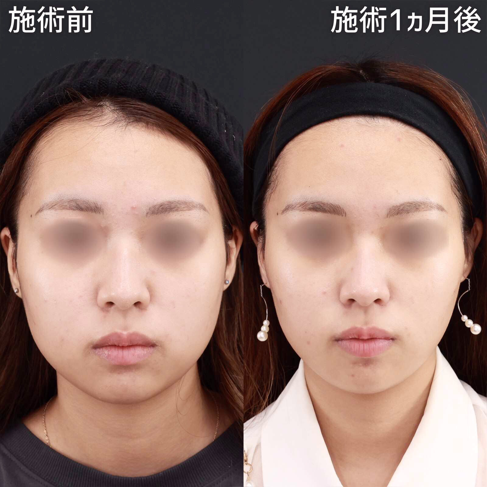 【糸リフト&amp;バッカルファット除去&amp;エラボツリヌストキシン】お顔を一回り小さく！