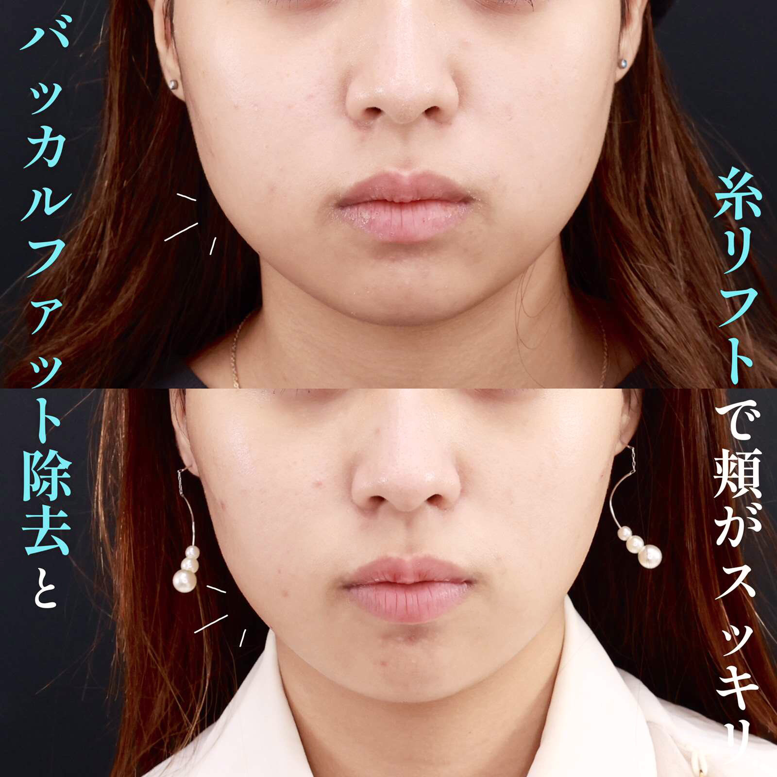 バッカルファット除去/TAC式 ツヤ肌コラーゲンリフト®/エラボトックス注射の症例写真 施術前後 