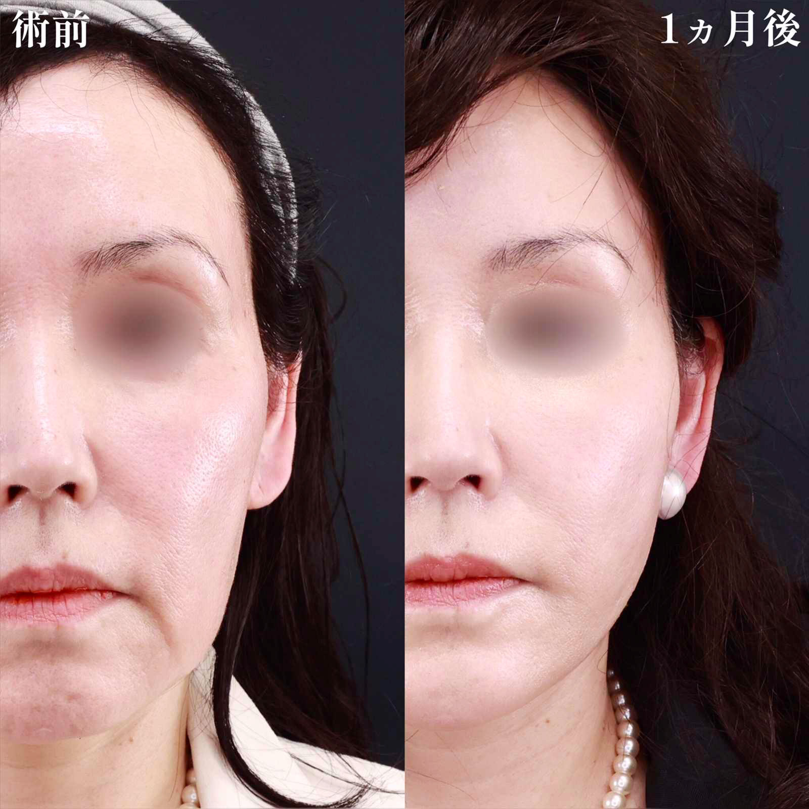 ジョールファット除去/TAC式 ツヤ肌コラーゲンリフト®/顎のヒアルロン酸注射の症例写真 施術前後 