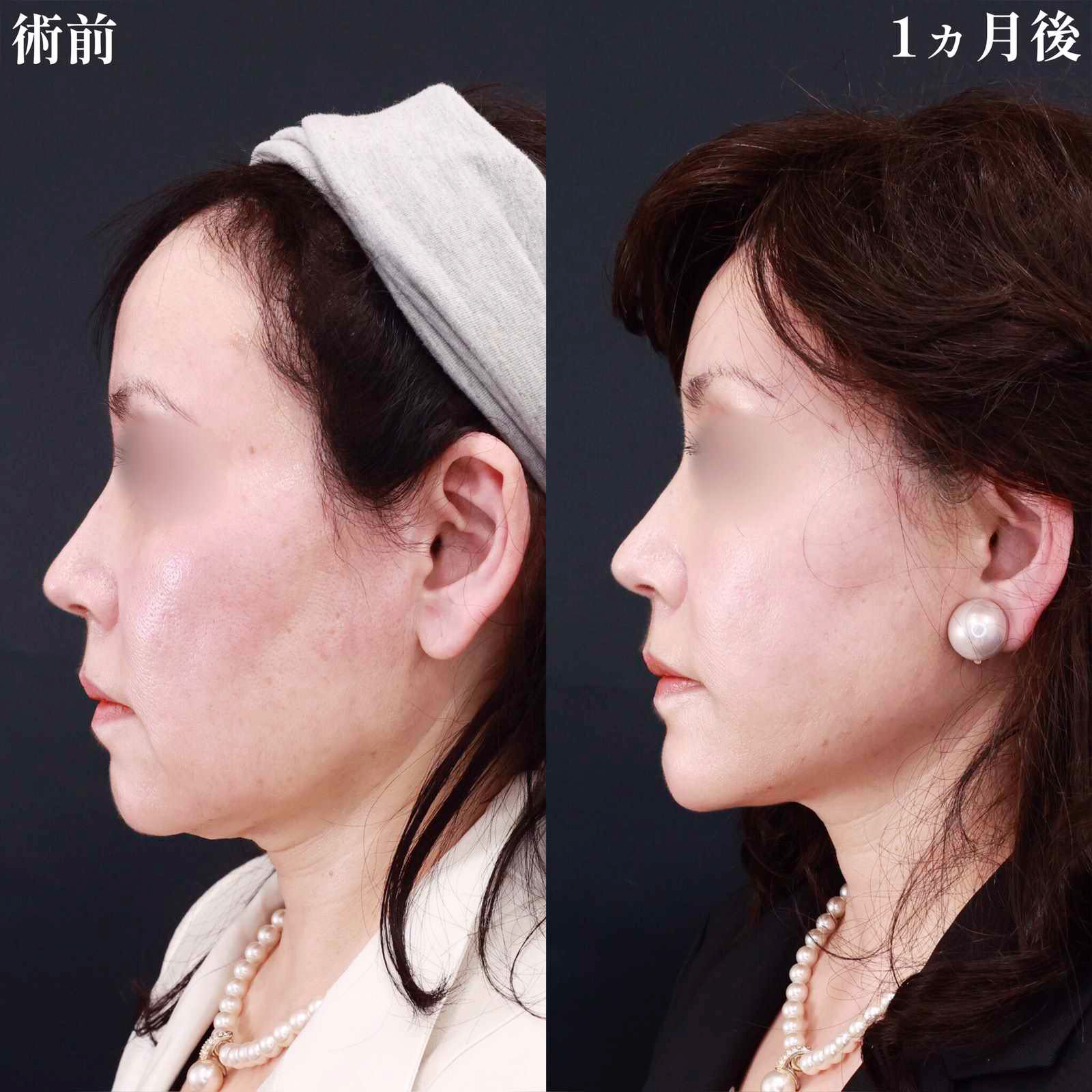 ジョールファット除去/TAC式 ツヤ肌コラーゲンリフト®/顎のヒアルロン酸注射の症例写真 施術前後 