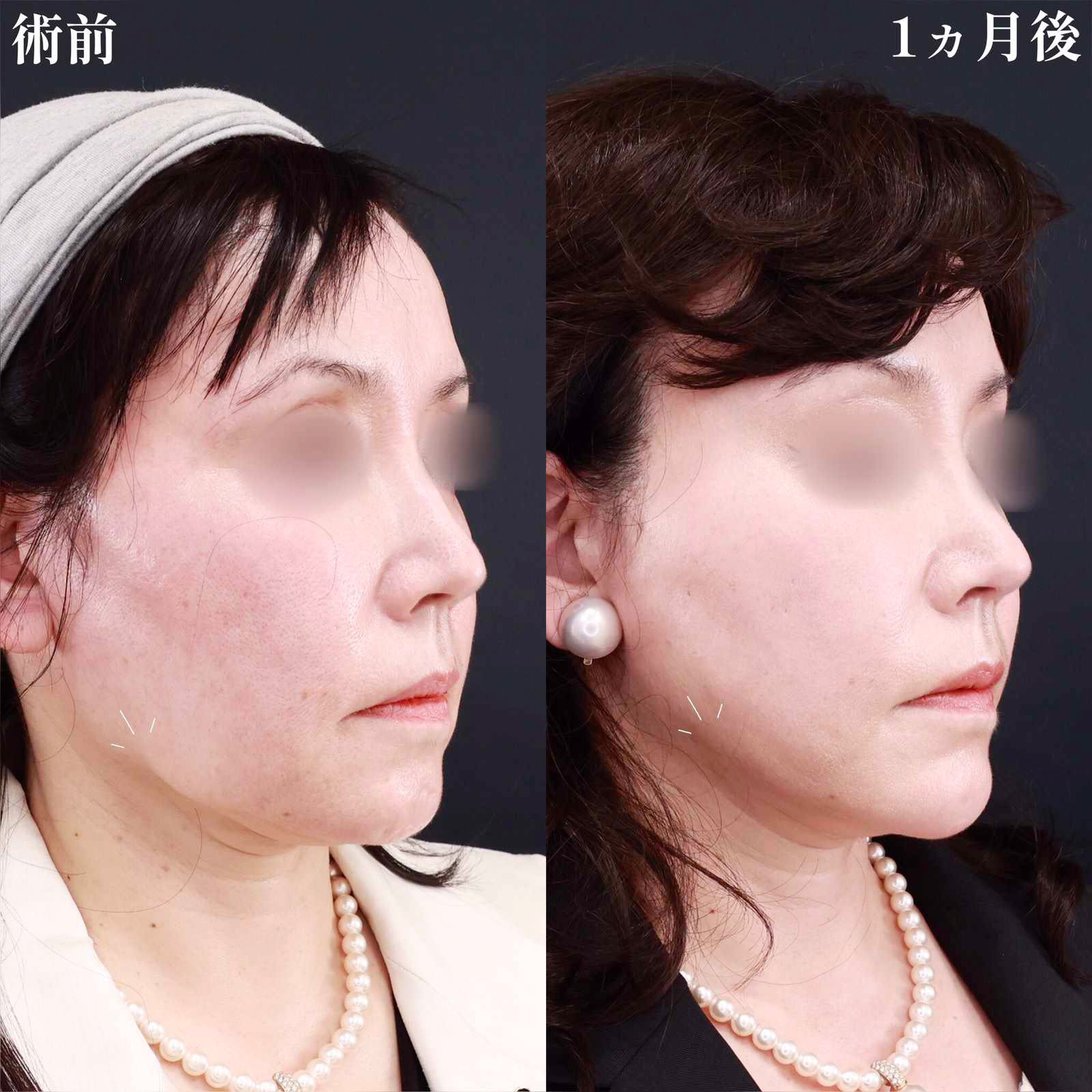 ジョールファット除去/TAC式 ツヤ肌コラーゲンリフト®/顎のヒアルロン酸注射の症例写真 施術前後 