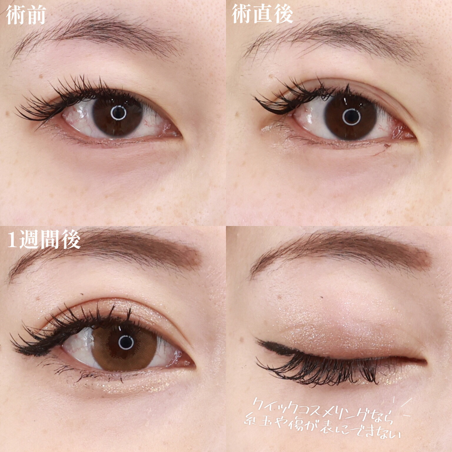 クイックコスメリングの症例写真 施術前後 
