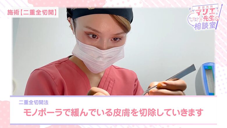 二重全切開でモノポーラを使用し、脂肪を切除する様子