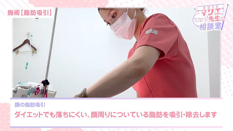小顔形成のため、落ちにくい顔周りの脂肪を吸引・除去する手術