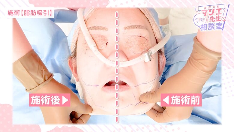顔の脂肪吸引の施術中における、施術前と施術後の圧倒的変化
