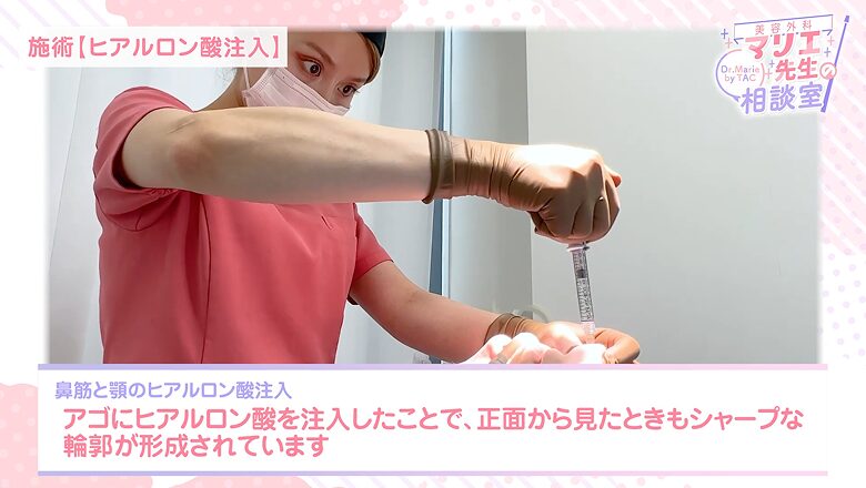 顎のヒアルロン酸注入により正面からもシャープな輪郭が形成される