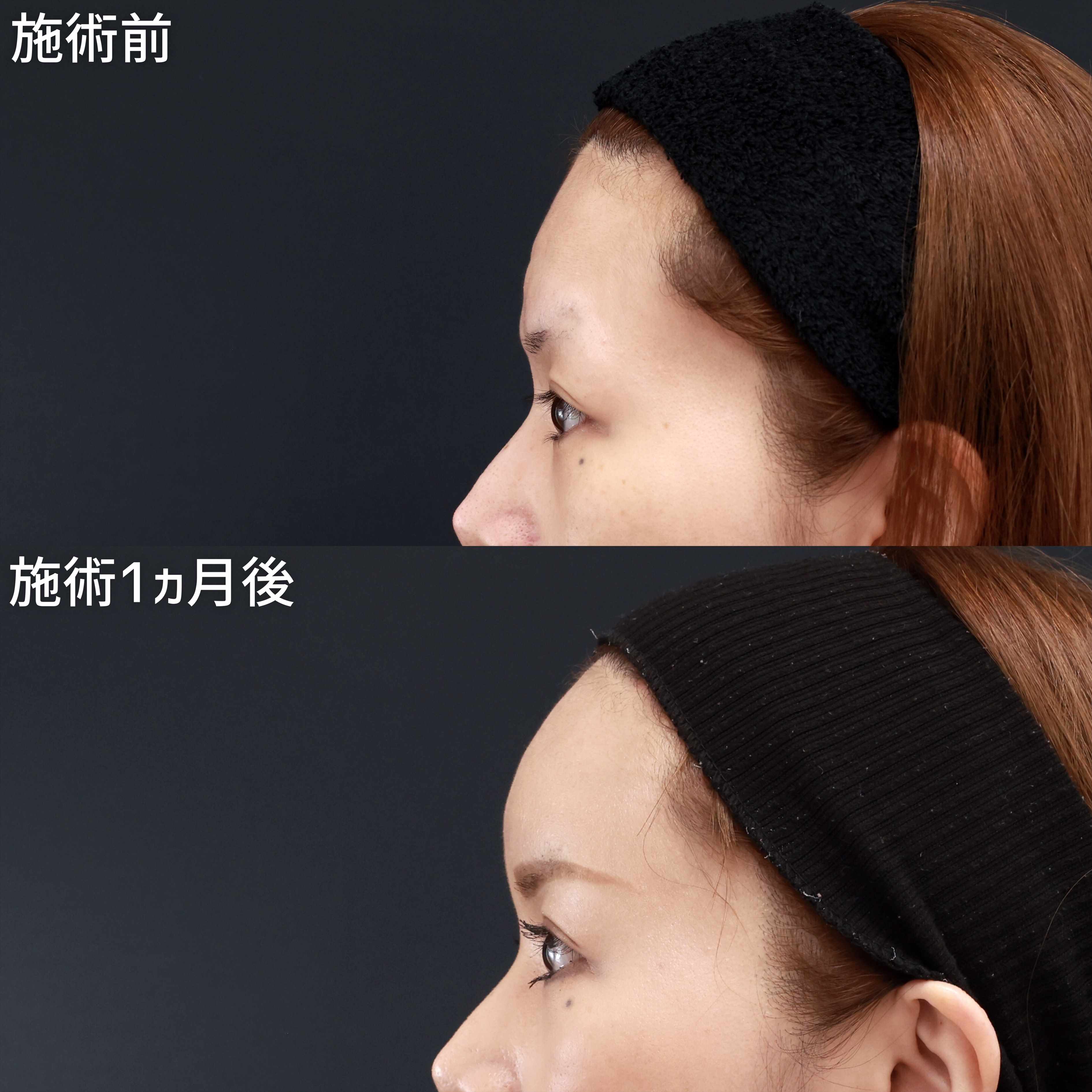 顔の脂肪注入(コンデンスリッチフェイス)/おでこの脂肪注入（オルチャンデコ形成）/おでこボトックス注射の症例写真 施術前後 