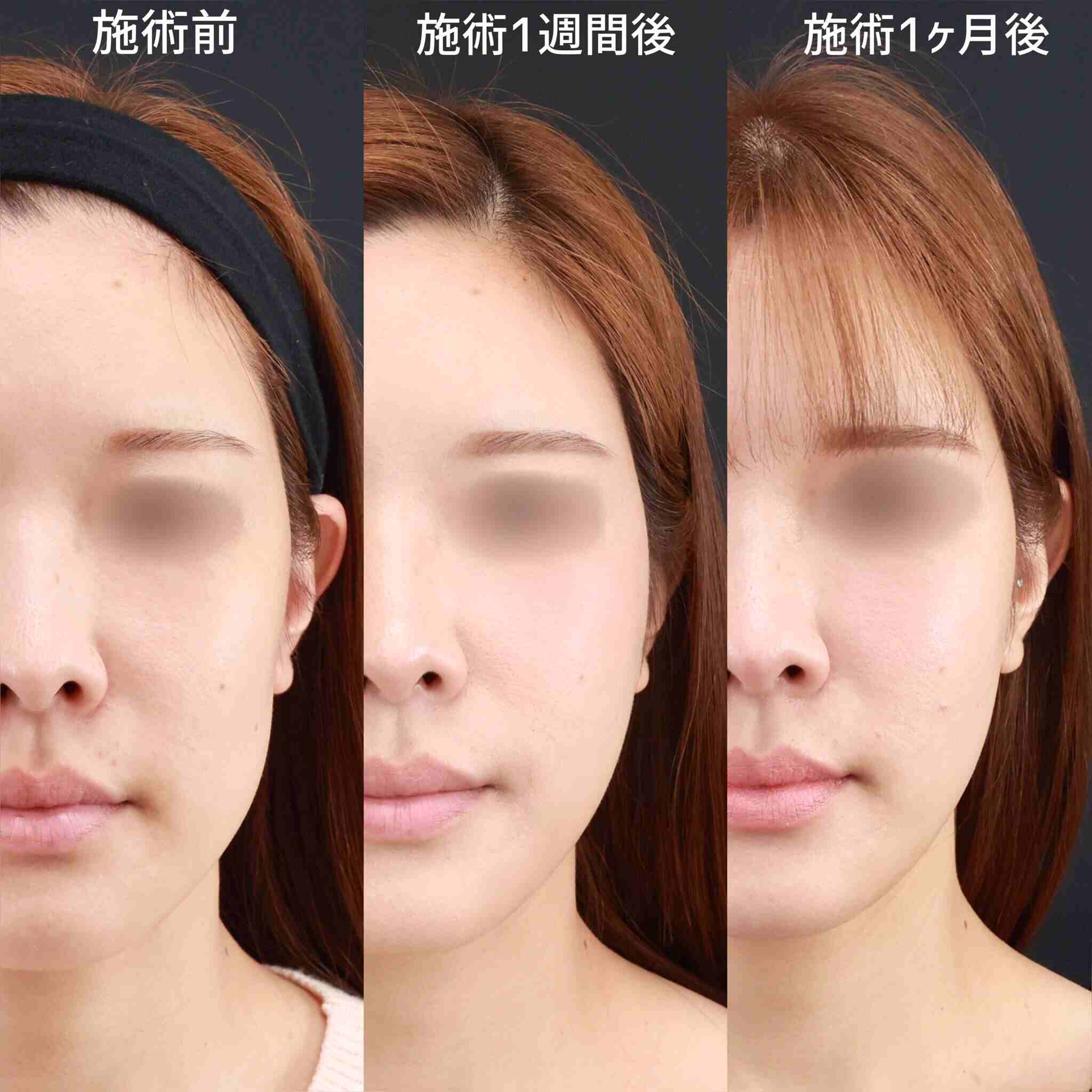 TAC式 ツヤ肌コラーゲンリフト®の症例写真 施術前後 