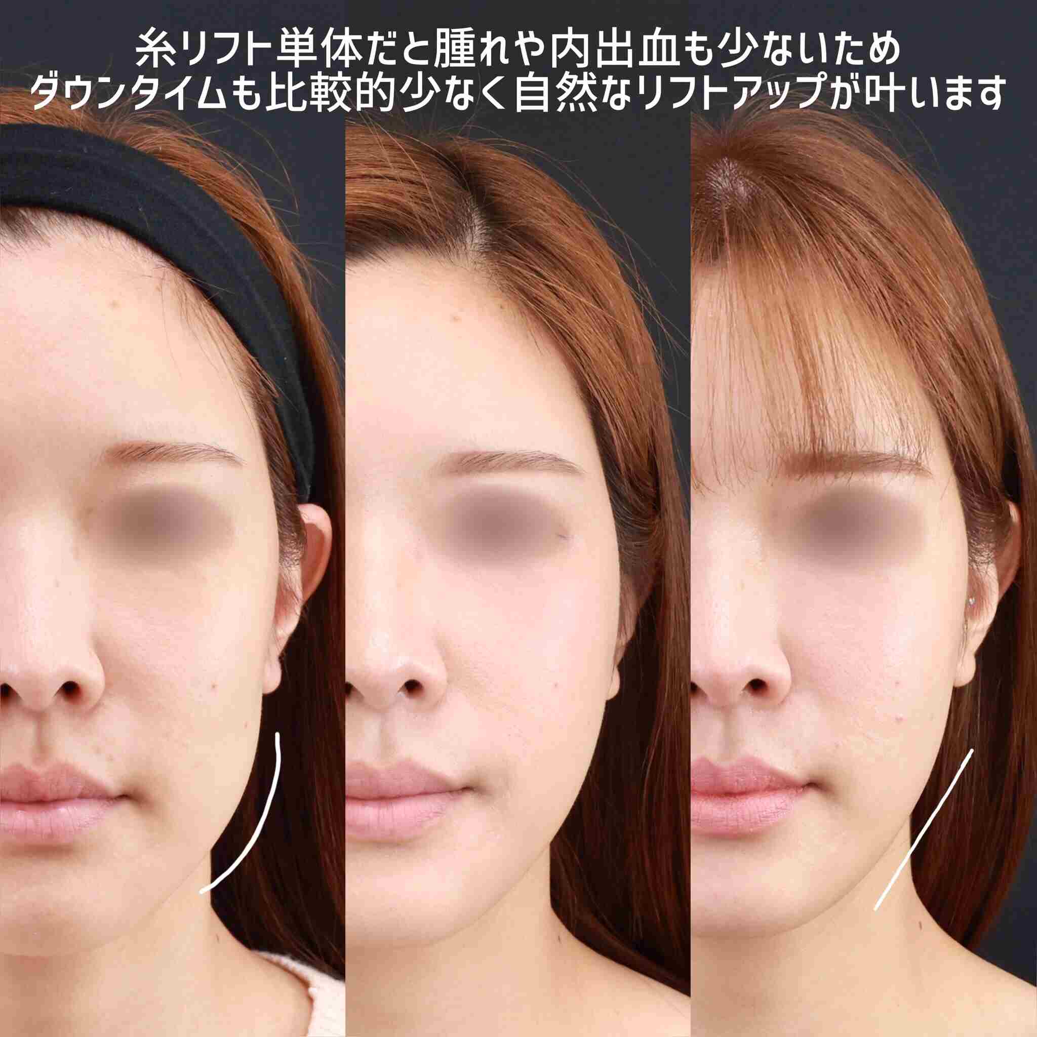 TAC式 ツヤ肌コラーゲンリフト®の症例写真 施術前後 術前～1週間～1ヵ月