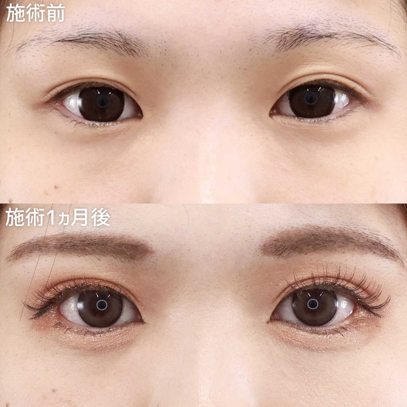 【二重埋没法＋グラマラスライン＋目尻切開】目元の複合オペで目を全方向に大きく！