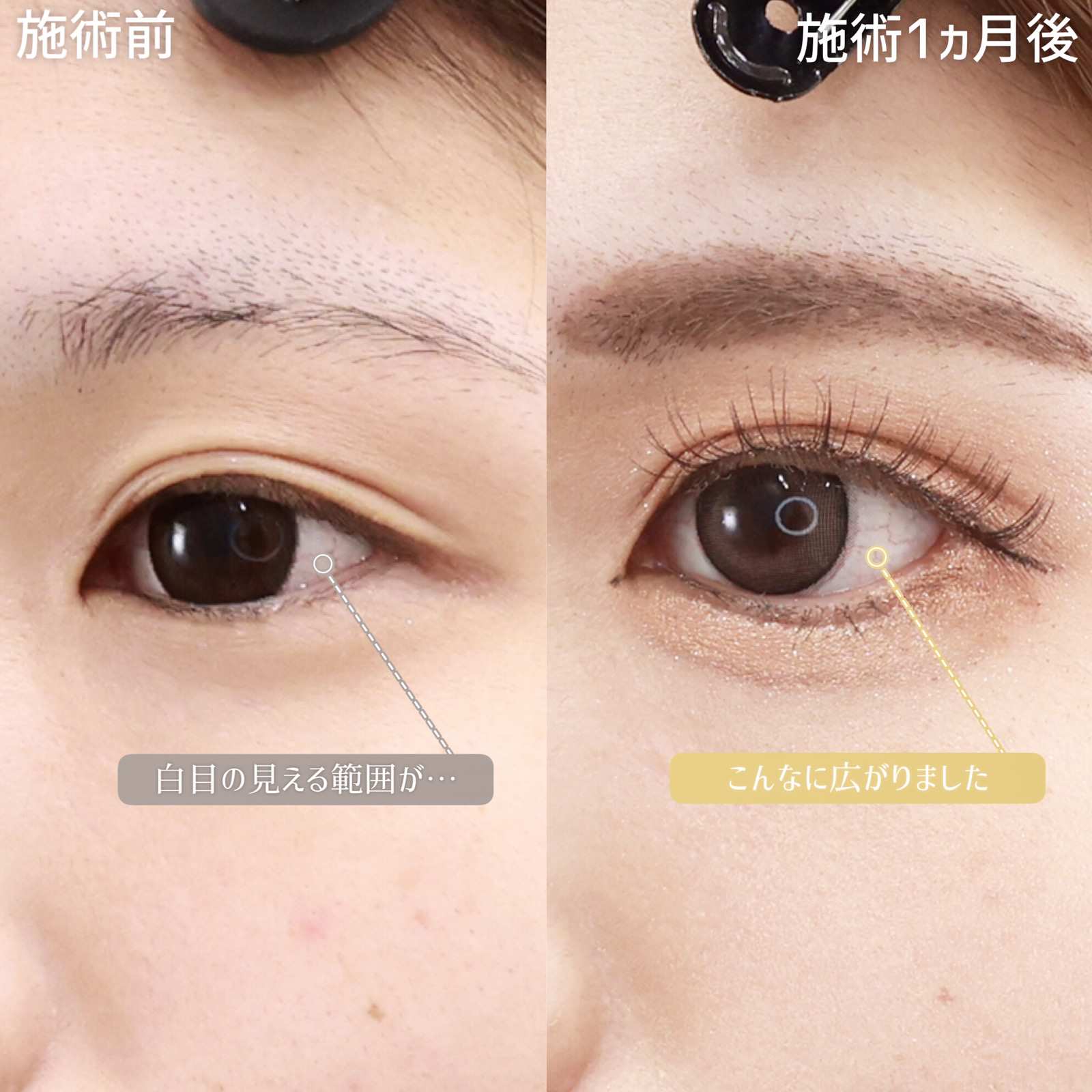 グラマラスライン（タレ目形成）/目尻切開術/下眼瞼脱脂術（目の下のたるみ取り・目の下の脂肪ふくらみ取り）の症例写真 施術前後 1ヵ月