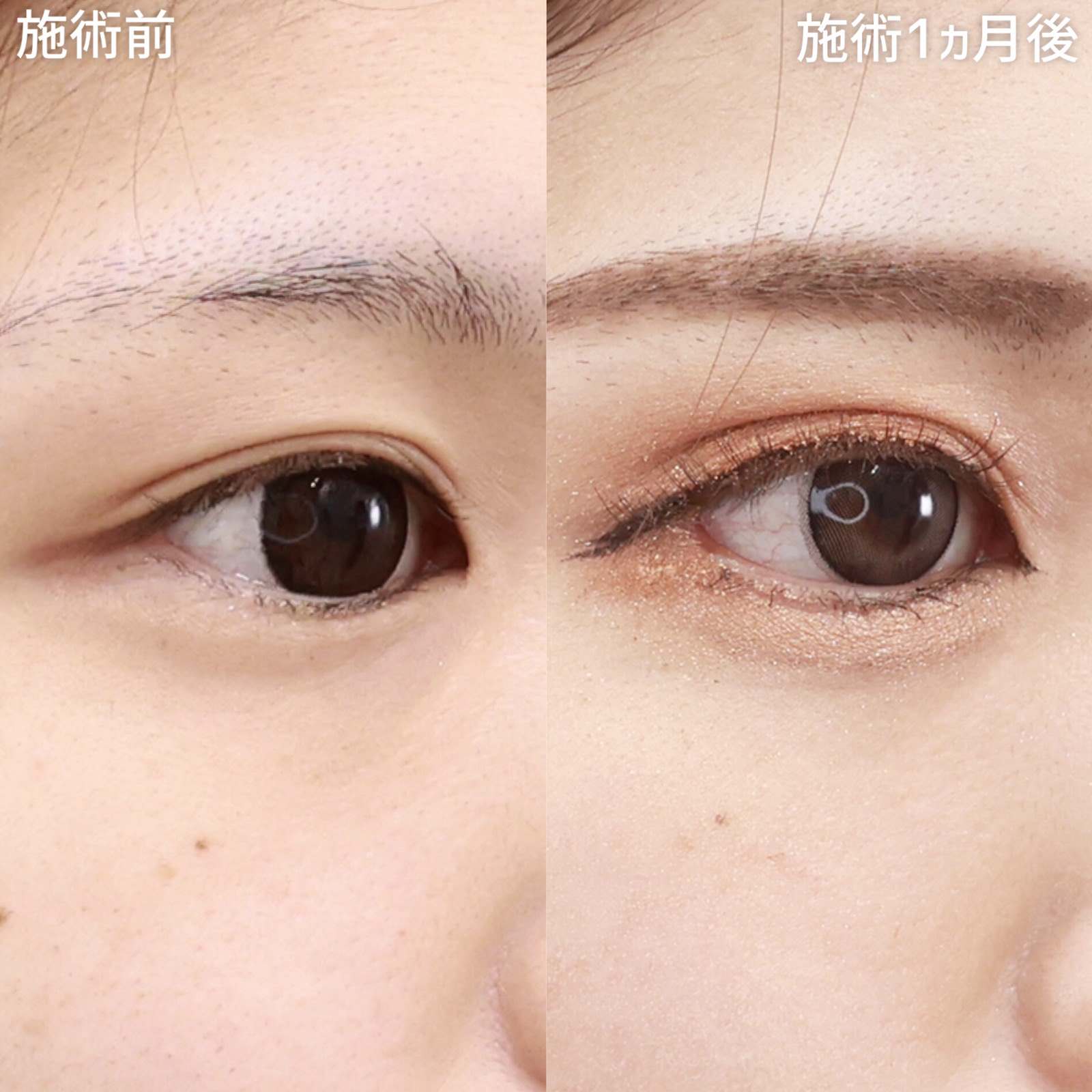 グラマラスライン（タレ目形成）/目尻切開術/下眼瞼脱脂術（目の下のたるみ取り・目の下の脂肪ふくらみ取り）の症例写真 施術前後 1ヵ月