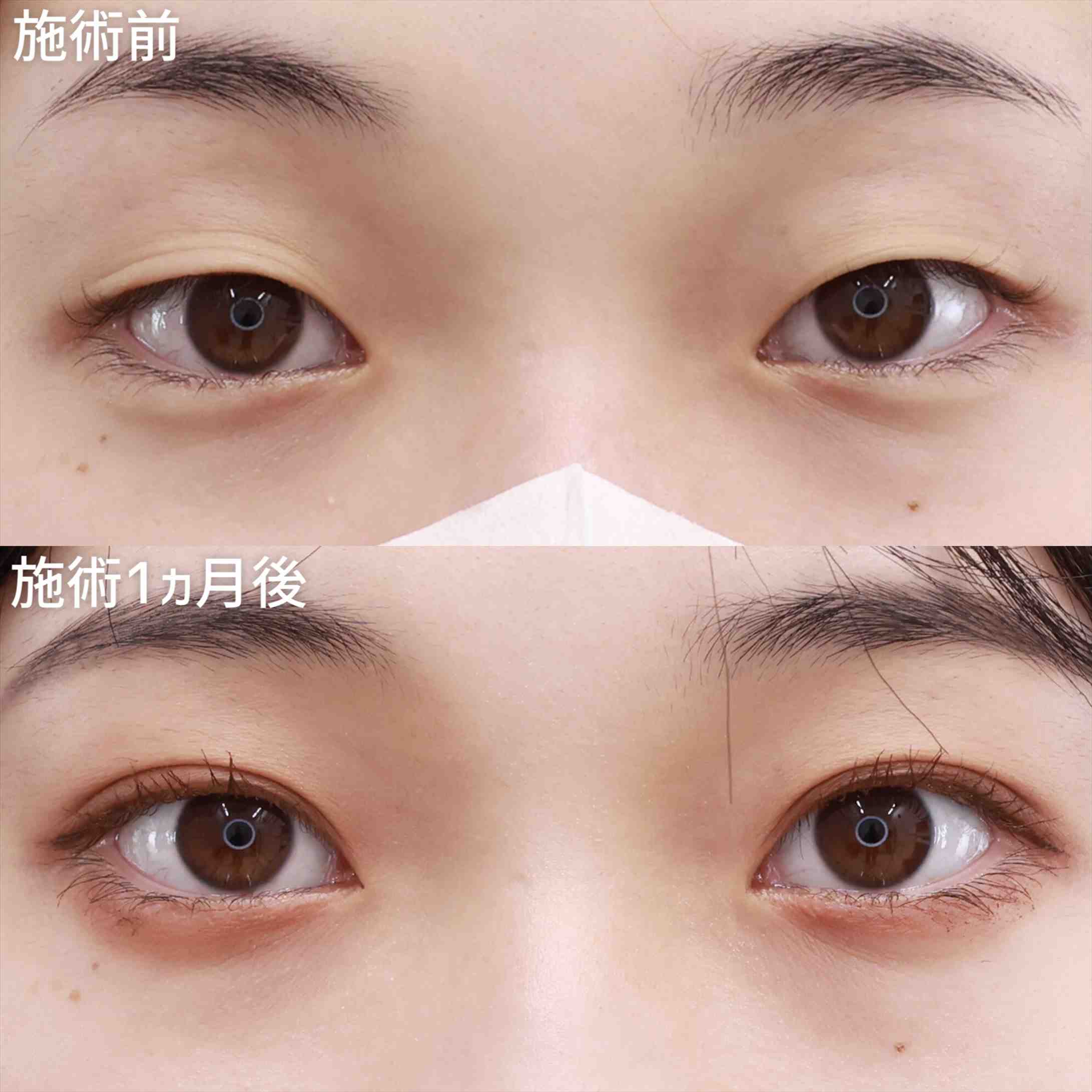 【クイックコスメリング】整形感なし！まるで生まれつきのような自然な二重に