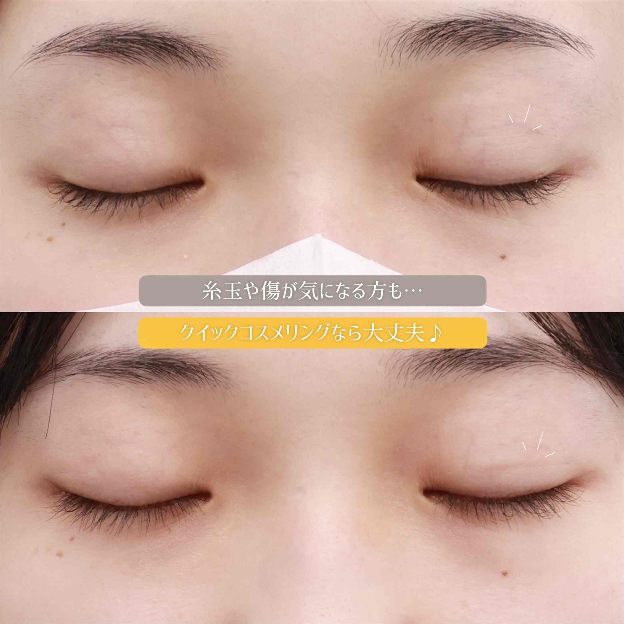 クイックコスメリングの症例写真 施術前後 