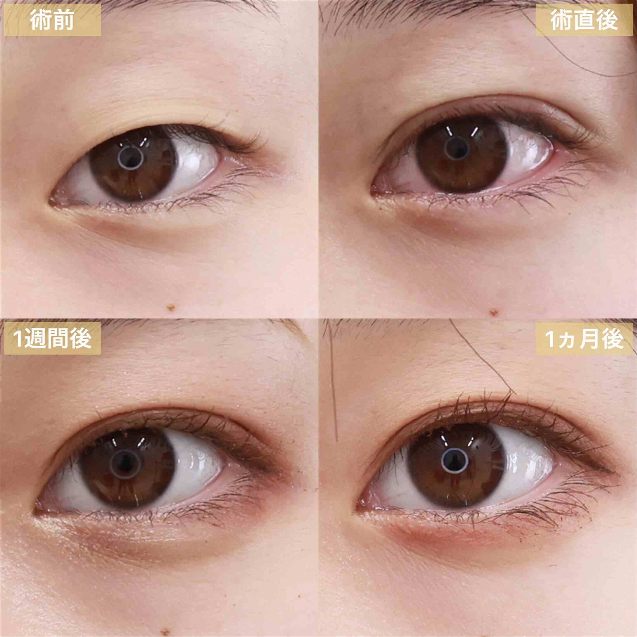 クイックコスメリングの症例写真 施術前後 