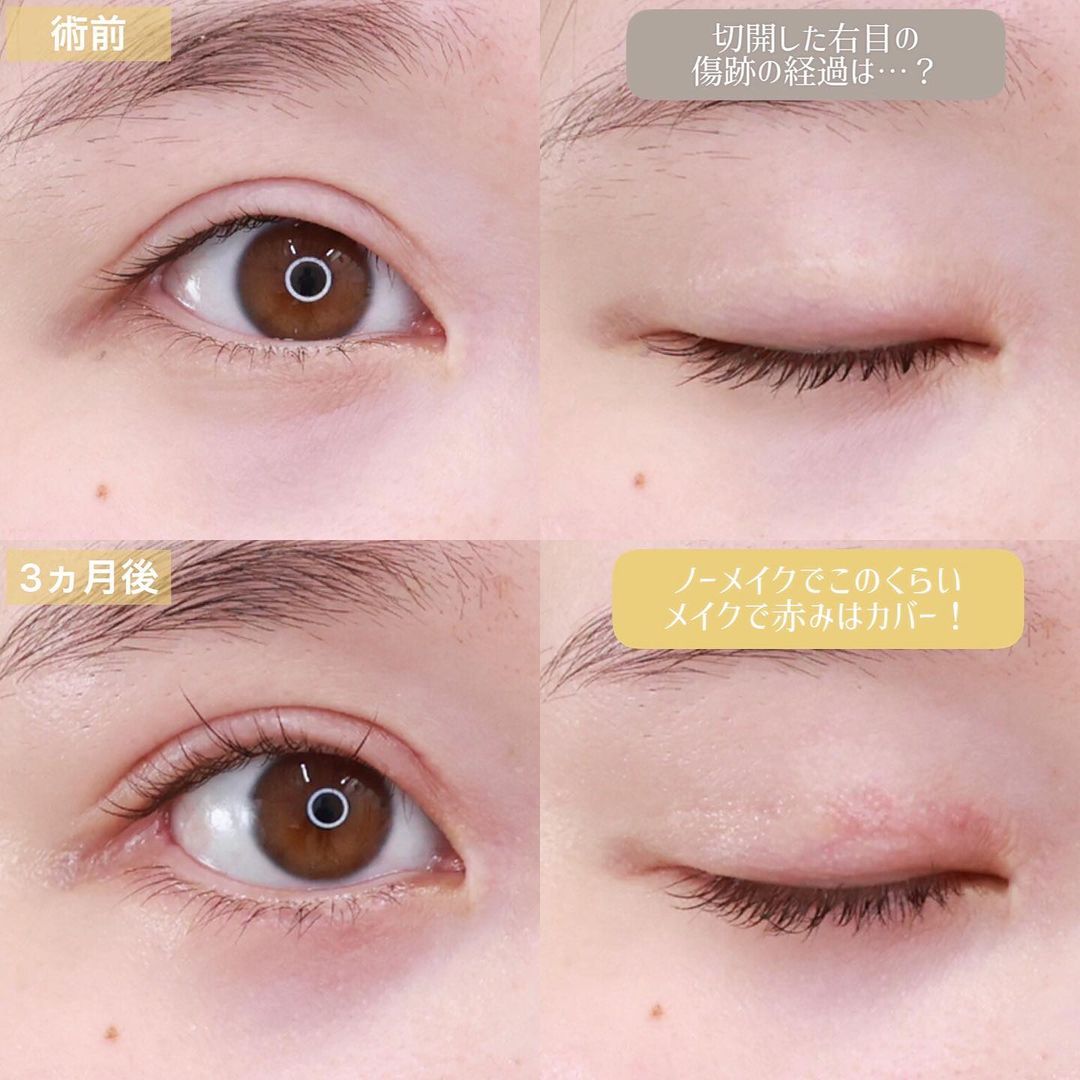 グラマラスライン（タレ目形成）/目尻切開術/下眼瞼脱脂術（目の下のたるみ取り・目の下の脂肪ふくらみ取り）の症例写真 施術前後 3ヵ月