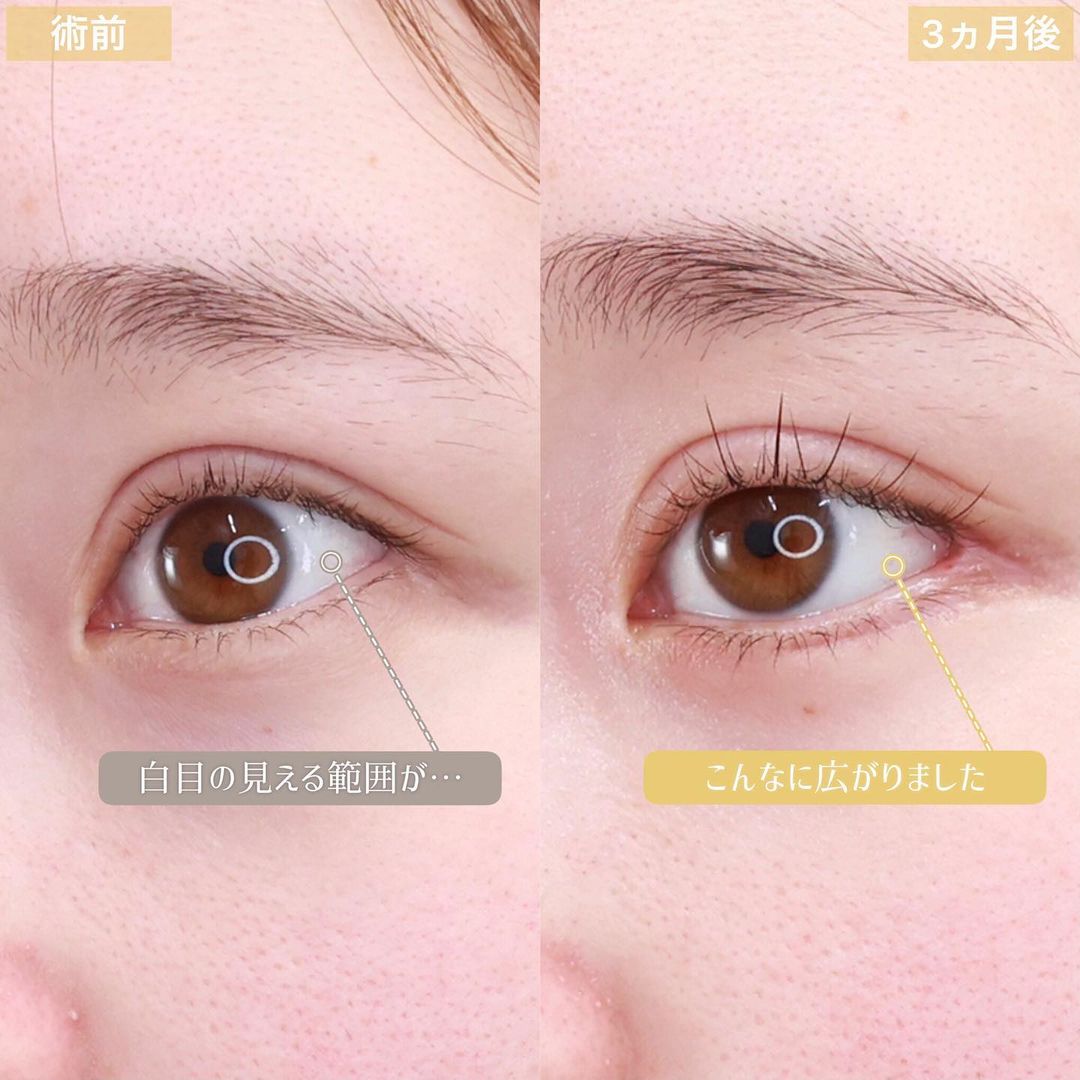 グラマラスライン（タレ目形成）/目尻切開術/下眼瞼脱脂術（目の下のたるみ取り・目の下の脂肪ふくらみ取り）の症例写真 施術前後 3ヵ月
